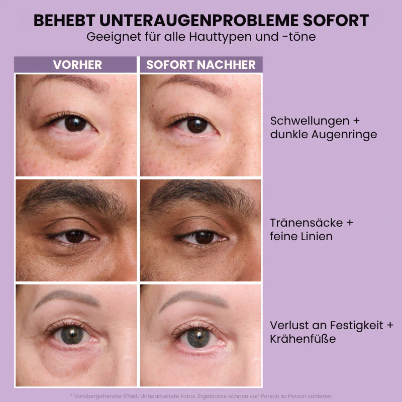 EyeLift™ | Entfernt 98 % aller Augenringe & Falten sofort!