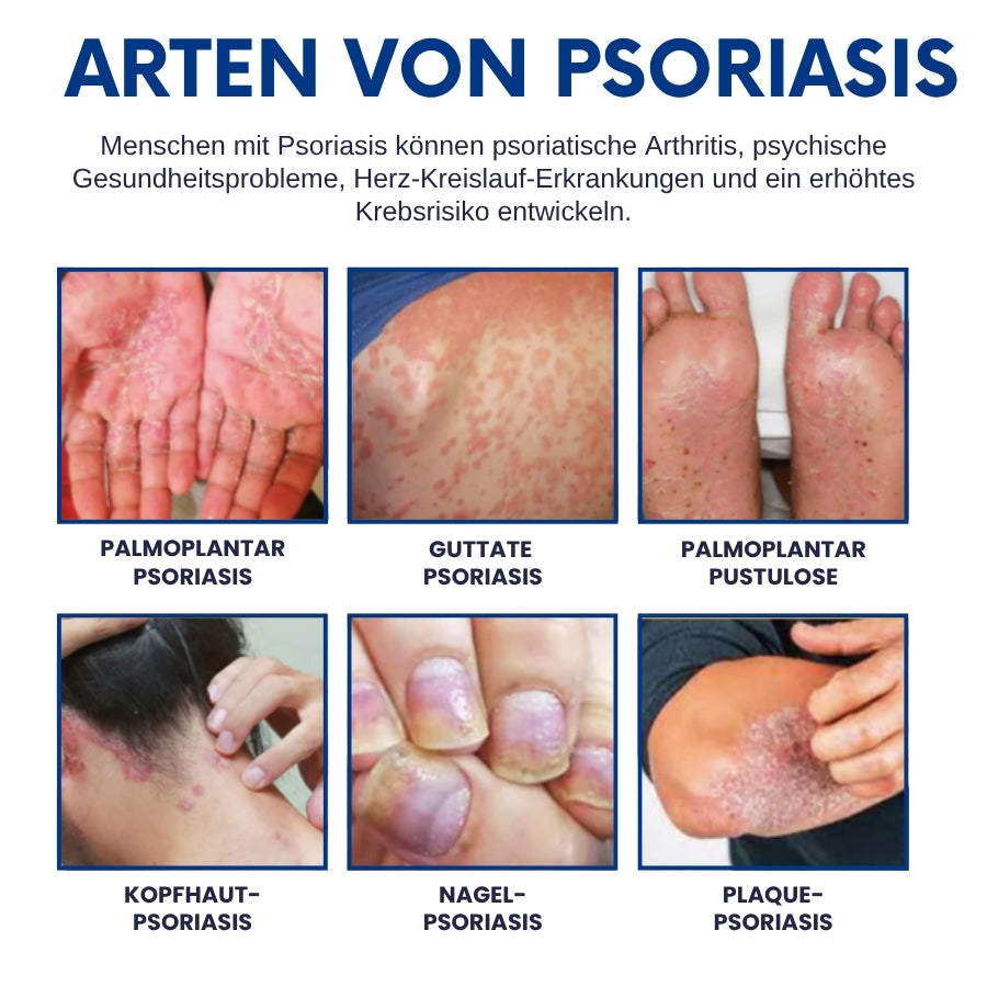 CuraSkin™ | Psoriasis- und Ekzem-Creme