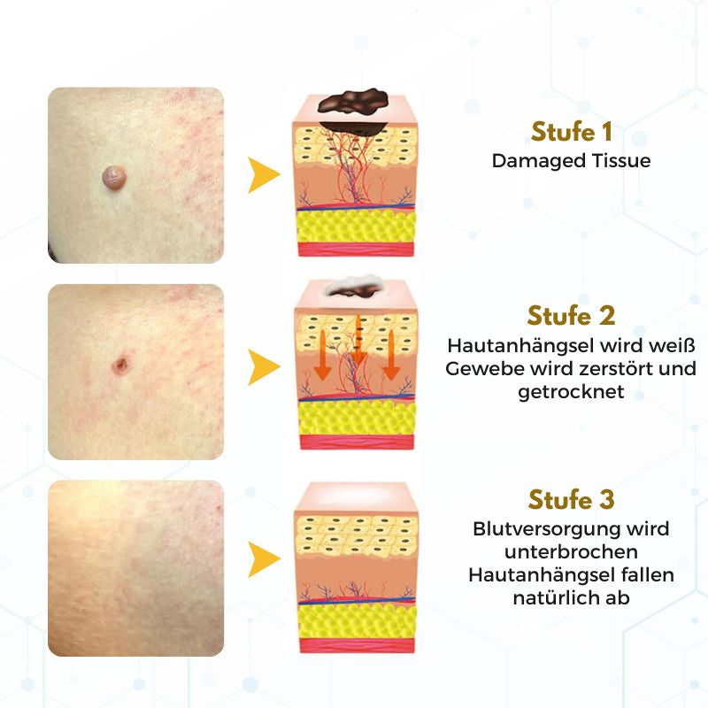 VanishPro™ | Hautpflege zur Entfernung von Hautflecken und Hautanhängseln