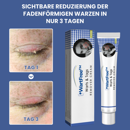 WartFree™ | Lösung zur Entfernung von Stielwarzen