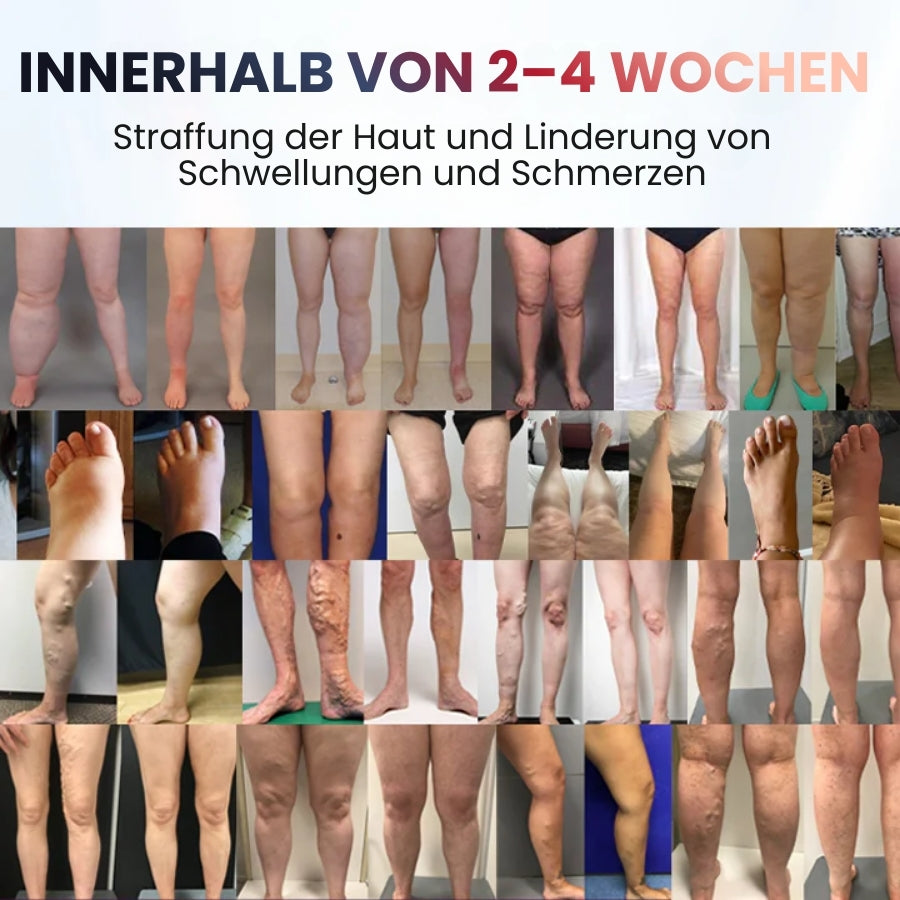 SwelRelief™ | Creme zur Linderung von Beinödemen