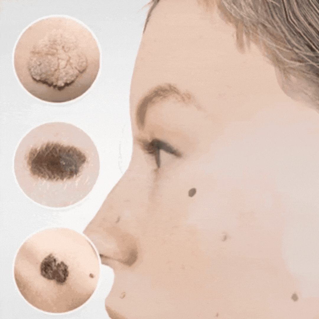 SpotFree™ | Serum gegen Warzen
