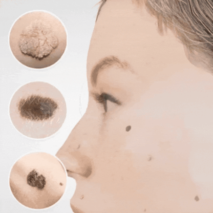 SpotFree™ | Serum gegen Warzen