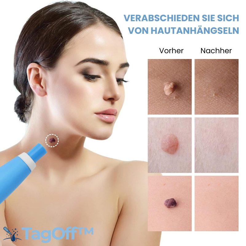 TagOff™ | Komplettset zur Entfernung von Hautanhängseln