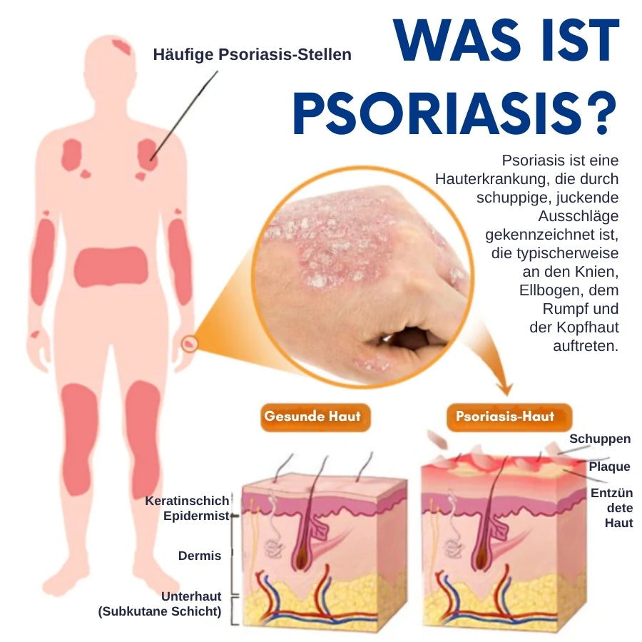 CuraSkin™ | Psoriasis- und Ekzem-Creme
