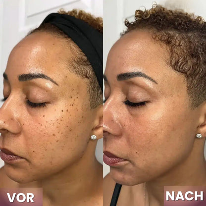 KeraErase™ | Pflanzliche Warzenentfernungscreme mit Doppelwirkung