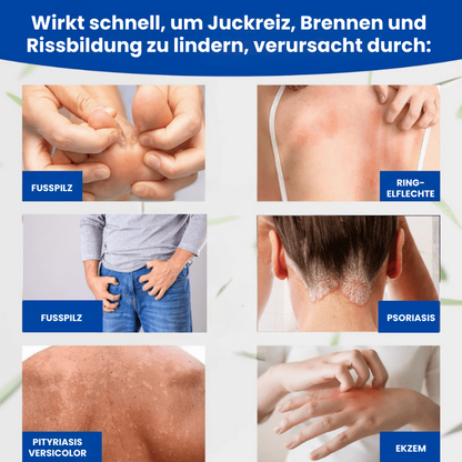 FungusFree™ | Antimykotische Creme