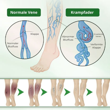 VeinFlex™ | Reduziere Krampfadern um 97 % in nur 2 Wochen!