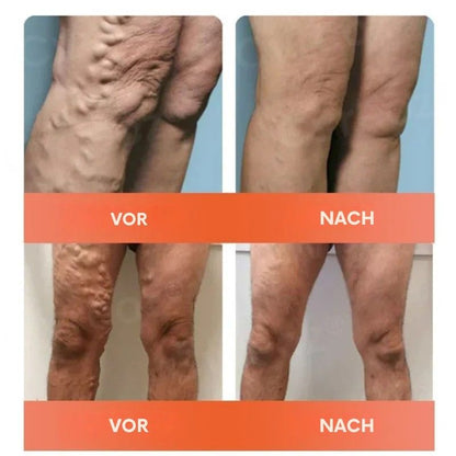 VitaVene™ | Natürliche Venenpflege-Kapseln