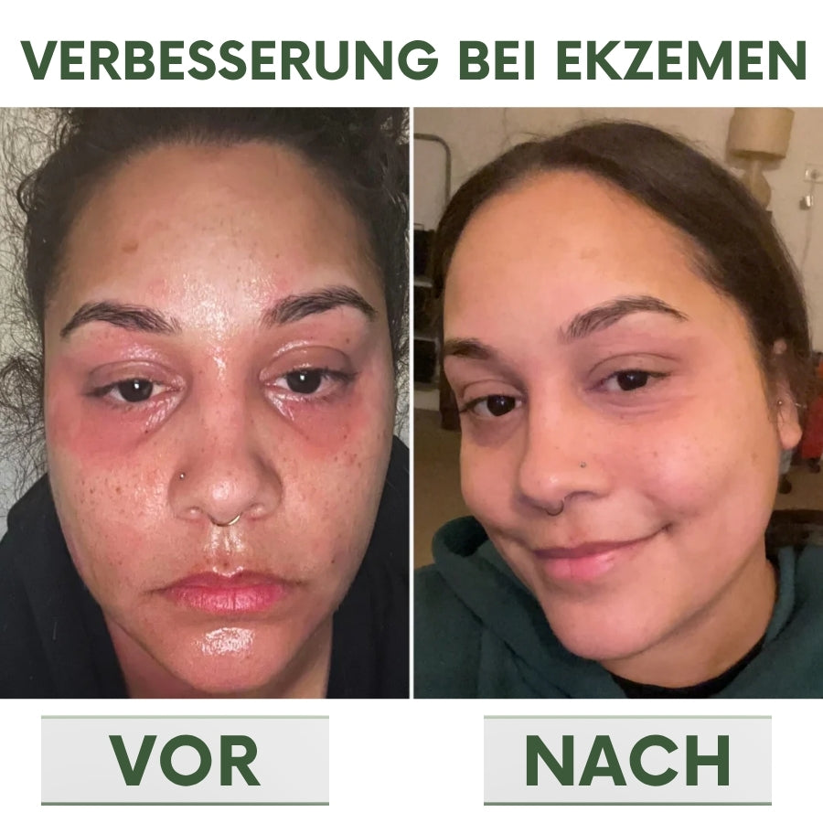 PsoriaCalm™ | Ekzem- und Psoriasis-Creme