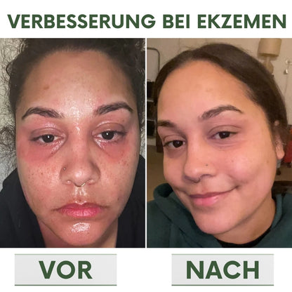 PsoriaCalm™ | Ekzem- und Psoriasis-Creme