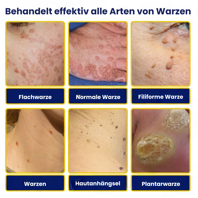 TagFree™ | Cryotherapie Hautanhängsel-Entferner-Spray