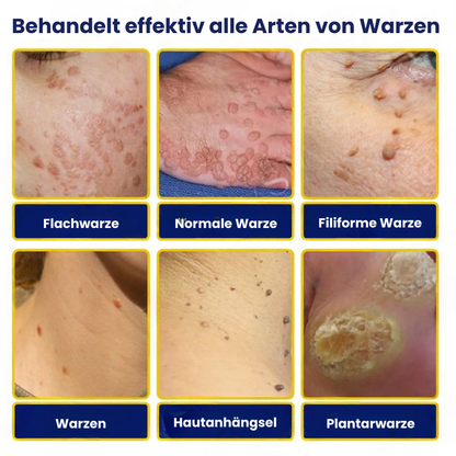 TagFree™ | Cryotherapie Hautanhängsel-Entferner-Spray