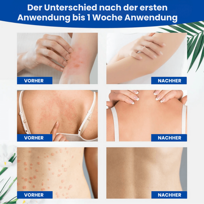 FungusFree™ | Antimykotische Creme