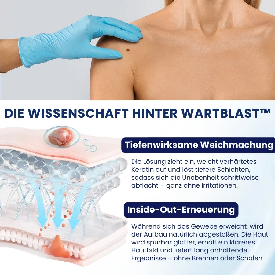 WartBlast™ | Warzen- und Hühneraugen-Entfernungsflüssigkeit