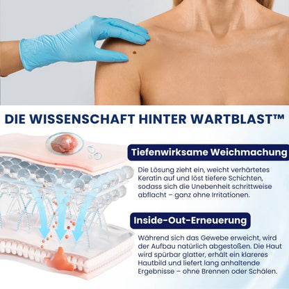 WartBlast™ | Warzen- und Hühneraugen-Entfernungsflüssigkeit