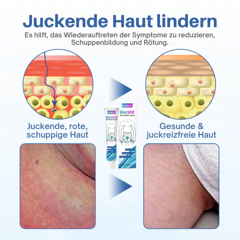 GentCare™ | Creme zur Linderung von Genitalwarzen