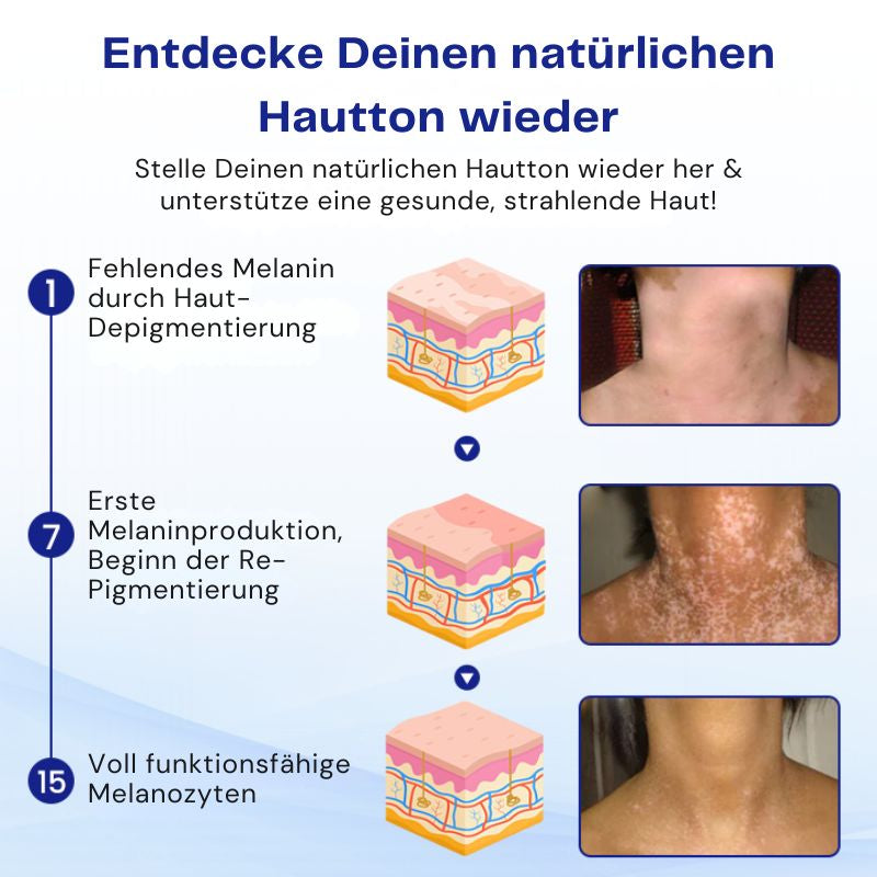VitiClear™ | Unterstützt 3× schnellere Repigmentierung – sichtbare Ergebnisse in 2 Wochen!