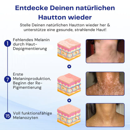 VitiClear™ | Unterstützt 3× schnellere Repigmentierung – sichtbare Ergebnisse in 2 Wochen!