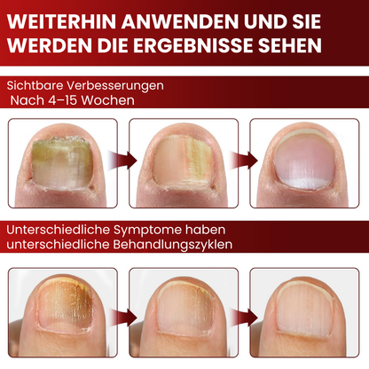 NailGuard™ | Behandlung von Fußnagelpilz