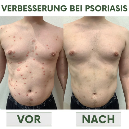 PsoriaCalm™ | Ekzem- und Psoriasis-Creme