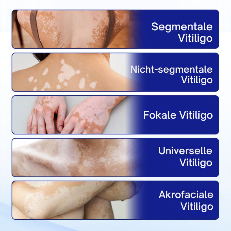 VitiClear™ | Unterstützt 3× schnellere Repigmentierung – sichtbare Ergebnisse in 2 Wochen!