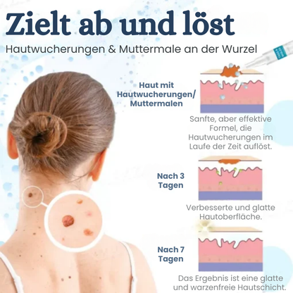 TagGone™ | Tags- und Muttermalentferner