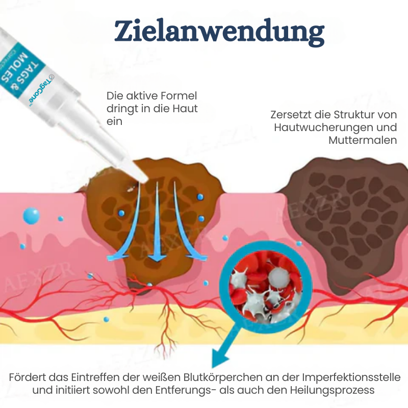 TagGone™ | Tags- und Muttermalentferner