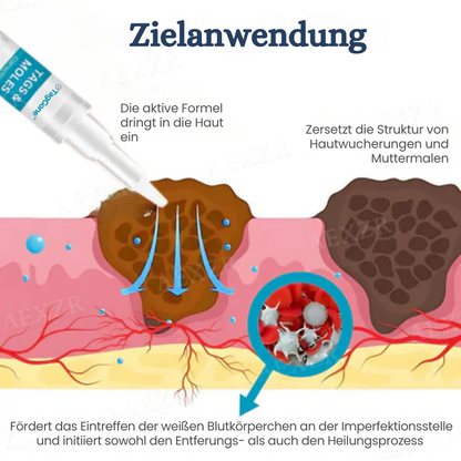 TagGone™ | Tags- und Muttermalentferner