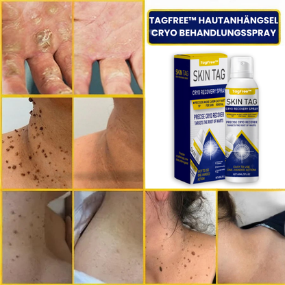 TagFree™ | Cryotherapie Hautanhängsel-Entferner-Spray