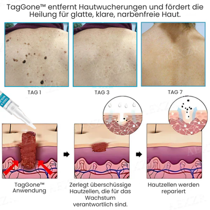 TagGone™ | Tags- und Muttermalentferner