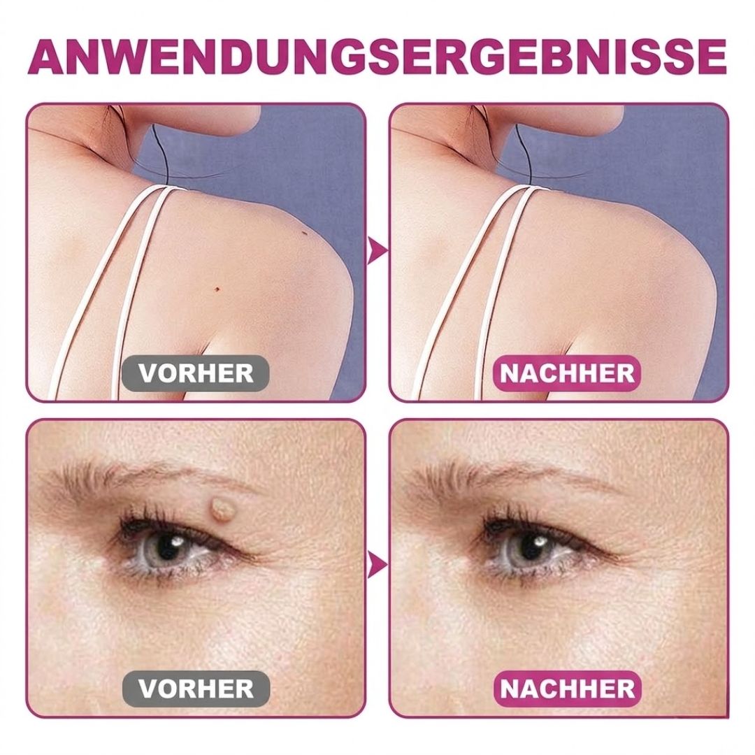 WartAway™ | Warzenentfernungscreme