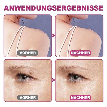 WartAway™ | Warzenentfernungscreme