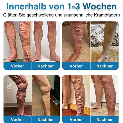 VeinRepair™ | Mikronadel-Pflaster