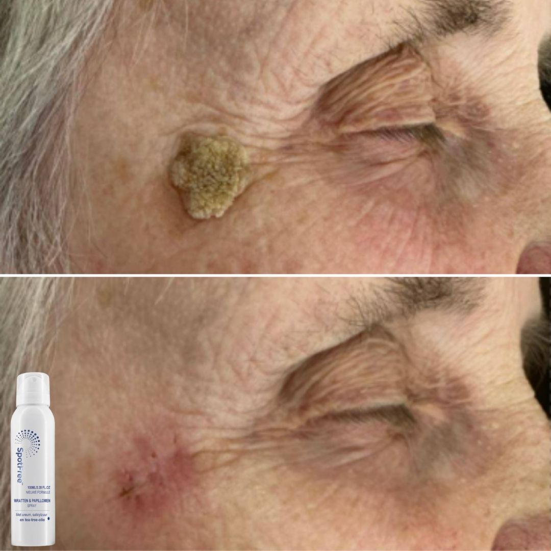 SpotFree™ | Serum gegen Warzen