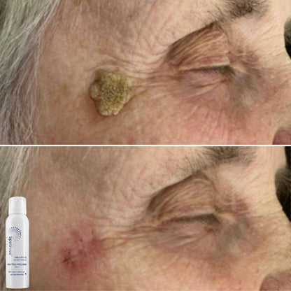 SpotFree™ | Serum gegen Warzen
