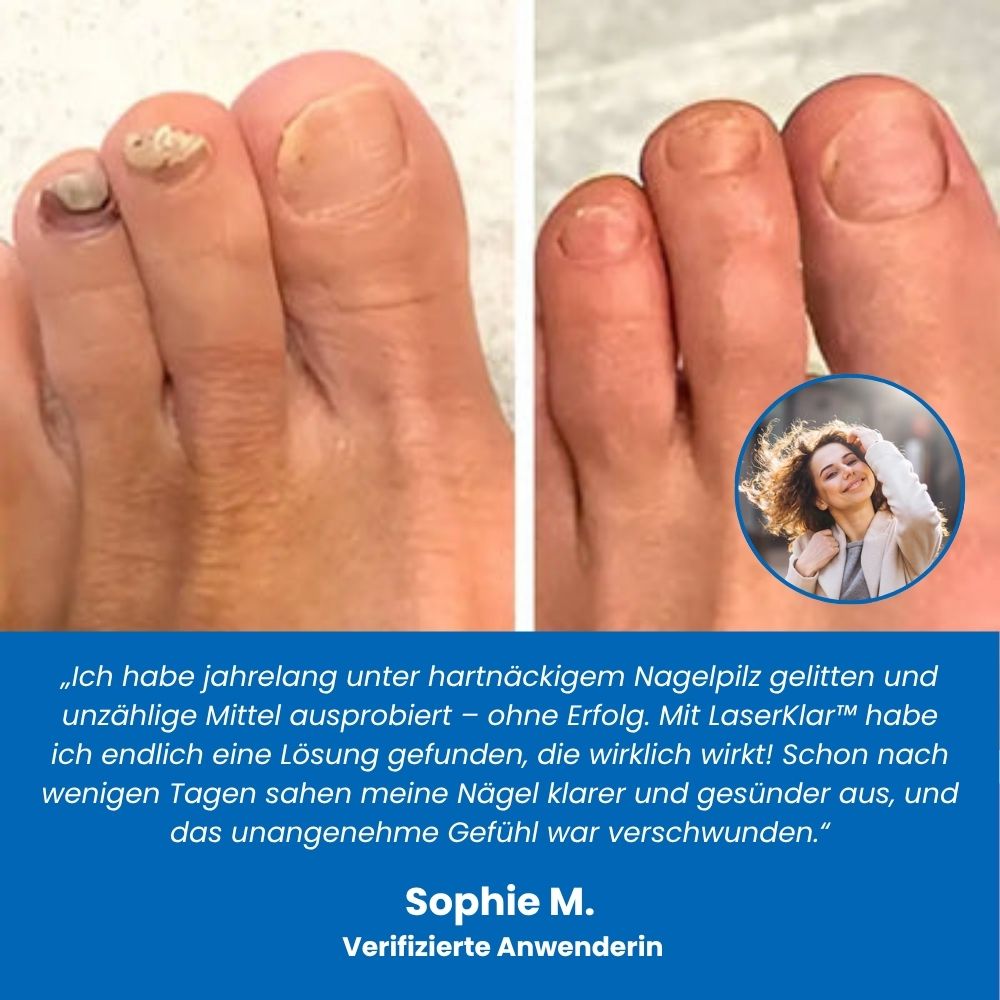LaserKlar™ | Medizinischer Nagelpilz-Laser