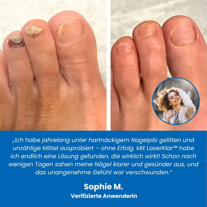 LaserKlar™ | Medizinischer Nagelpilz-Laser