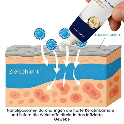 SureClear™  | Genitalwarzen-Entfernungscreme