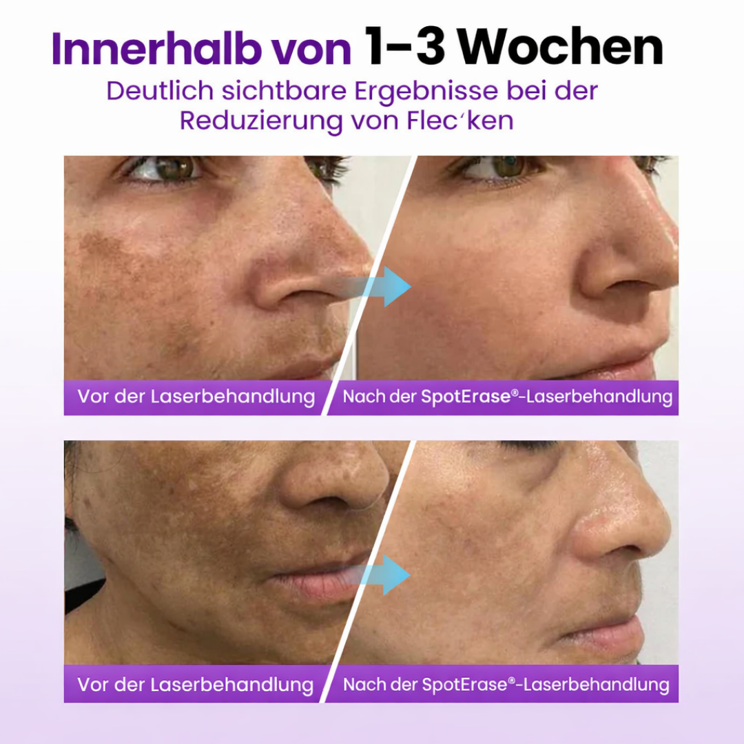 SpotErase™ | Tiefenpflege für das Gesicht