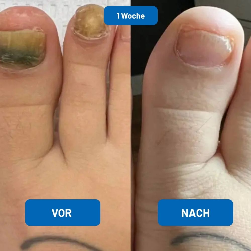 LaserKlar™ | Medizinischer Nagelpilz-Laser