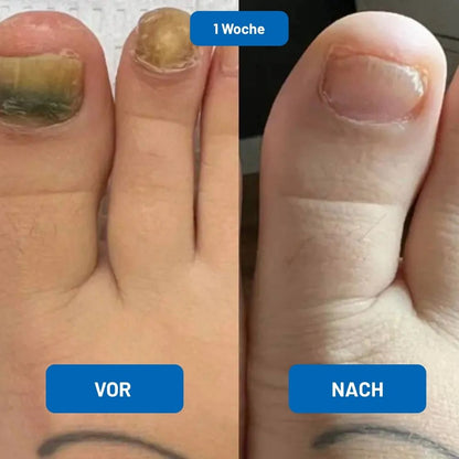 LaserKlar™ | Medizinischer Nagelpilz-Laser