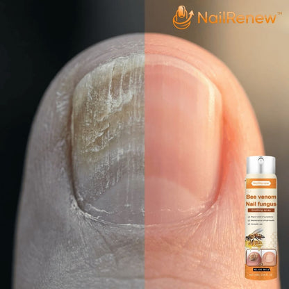 NailRenew™  | Nagelspray