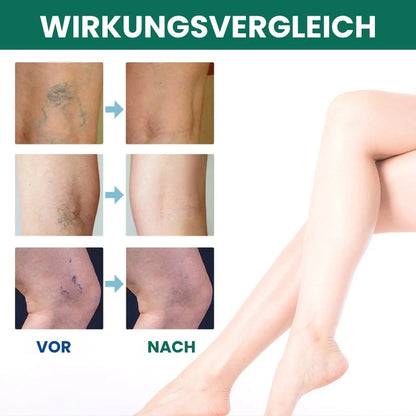 VeinRelief™ | Spray zur Linderung von Krampfadern