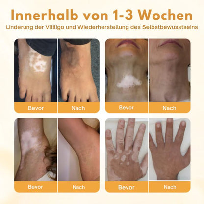VitiClear™ | Bienengift Vitiligo Creme