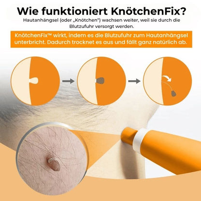 KnötchenFix™ | Hautanhängsel-Entferner Set