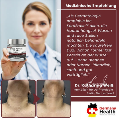 KeraErase™ | Pflanzliche Warzenentfernungscreme mit Doppelwirkung