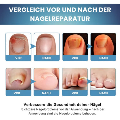 Nailixir™ | Nagelpilzbehandlungssalbe
