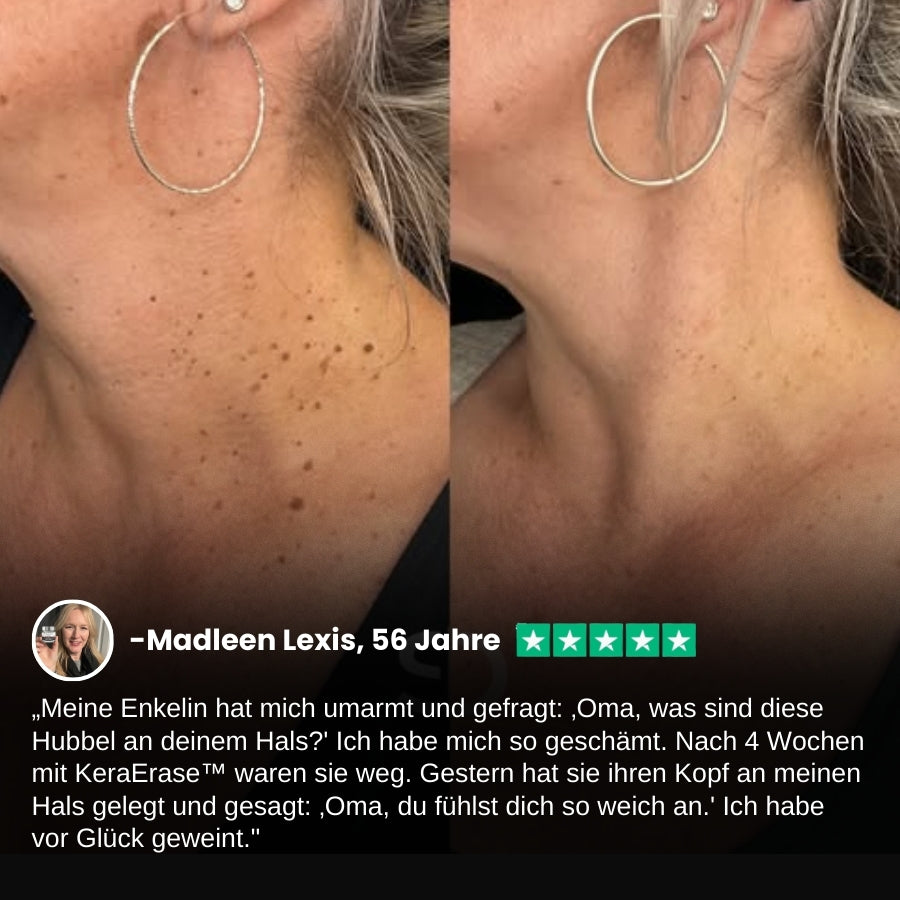 KeraErase™ | Pflanzliche Warzenentfernungscreme mit Doppelwirkung