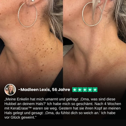 KeraErase™ | Pflanzliche Warzenentfernungscreme mit Doppelwirkung